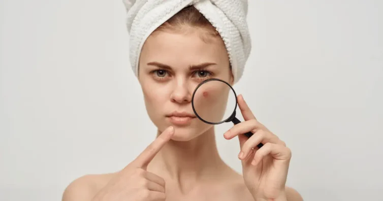 Млада жена с кърпа на главата държи лупа и показва пъпка на лицето си – грижа за кожата и лечение на акне