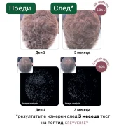 Преди и след 3 месеца употреба на Greyverse™ – видимо намаляване на побеляването на косата с 30% и повишена пигментация според дерматологично изследване.