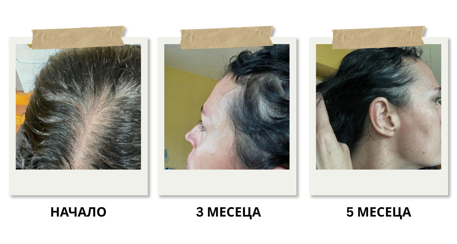 Сравнителни снимки на скалпа и косата на жена в 3 етапа – в началото, след 3 месеца и след 5 месеца употреба на Hair Color Restore с Greyverse™, показващи възстановяване на естествения цвят на косата