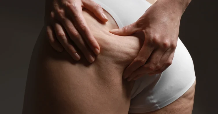 Жена, която притиска кожата на бедрото си, за да разбере какъв вид е нейния целулит